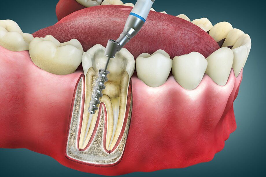 Choose Endodontic Care in a Dental Emergency