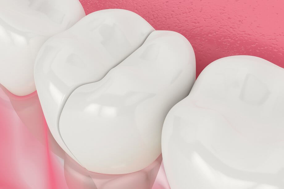 How to Prevent Cracked Teeth During Sports and Daily Activities